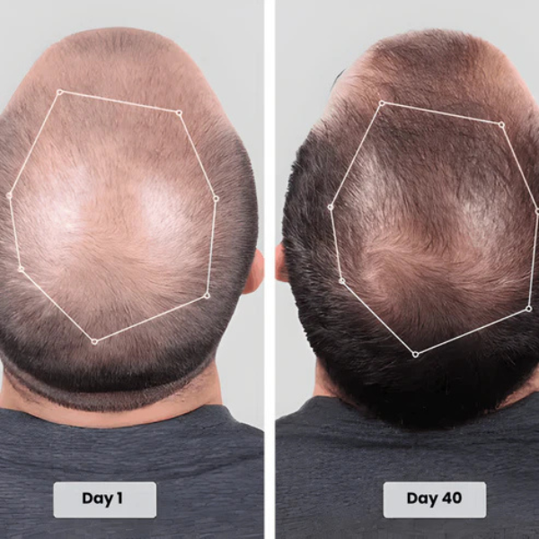 Red Light Therapy Cap for Hair Regrowth